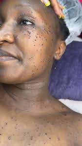 Laser Spot Removal Skin Tag Freckle ,Wart Mole ,Tattoo