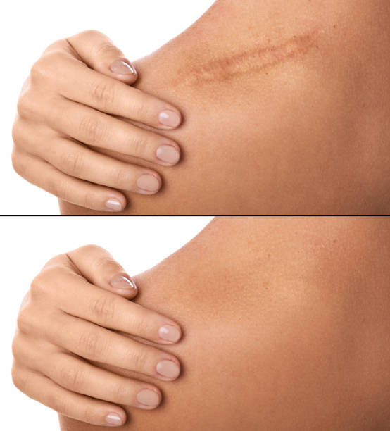 Keloid laser Scar Treatment